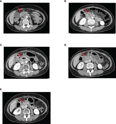 Case Report: A Case of Locally Advanced Pancreatic Cancer Which Achieved Progression Free for Over 12 Months by Subsequent Therapy with Anlotinib Hydrochloride Plus Tegafur-Gimeracil-Oteracil Potassium (TS-1)